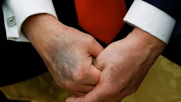 Tiny Bruised Hands